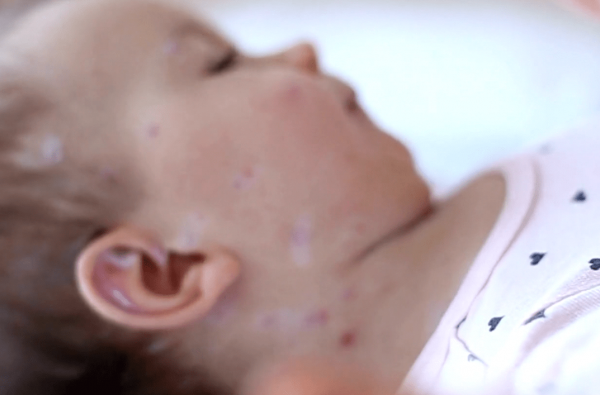 11 raste me fruth në Shqipëri, Tomini: Të infektuarit janë&hellip;